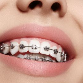 Aparatul Dentar – Mit sau Adevar? Iata TOP 15 lucruri pe care NU le stiai despre Ortodontie!